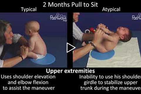 2 Month Old Baby Typical & Atypical Development Side by Side